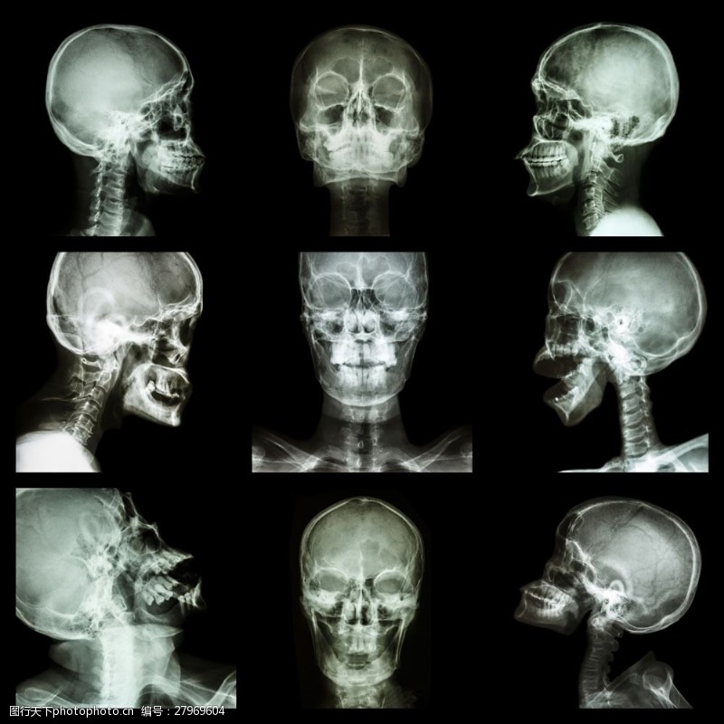 骨骼结构图脑X光片图图片
